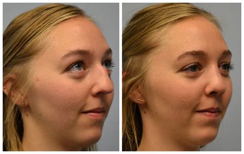 If you've accidentally bumped your nose after recently undergoing a rhinoplasty procedure, you should immediately apply a cold compress to help to reduce any . . Bumped nose after septoplasty